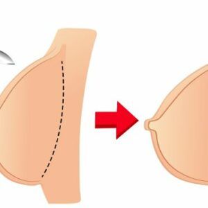 Θηλασμός μετά από αυξητική στήθους